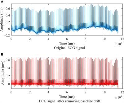 Detection and Localization of Myocardial Infarction Based on Multi-Scale ResNet and Attention Mechanism